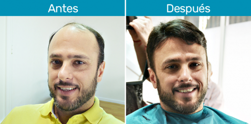 Protesis capilares HairDeline